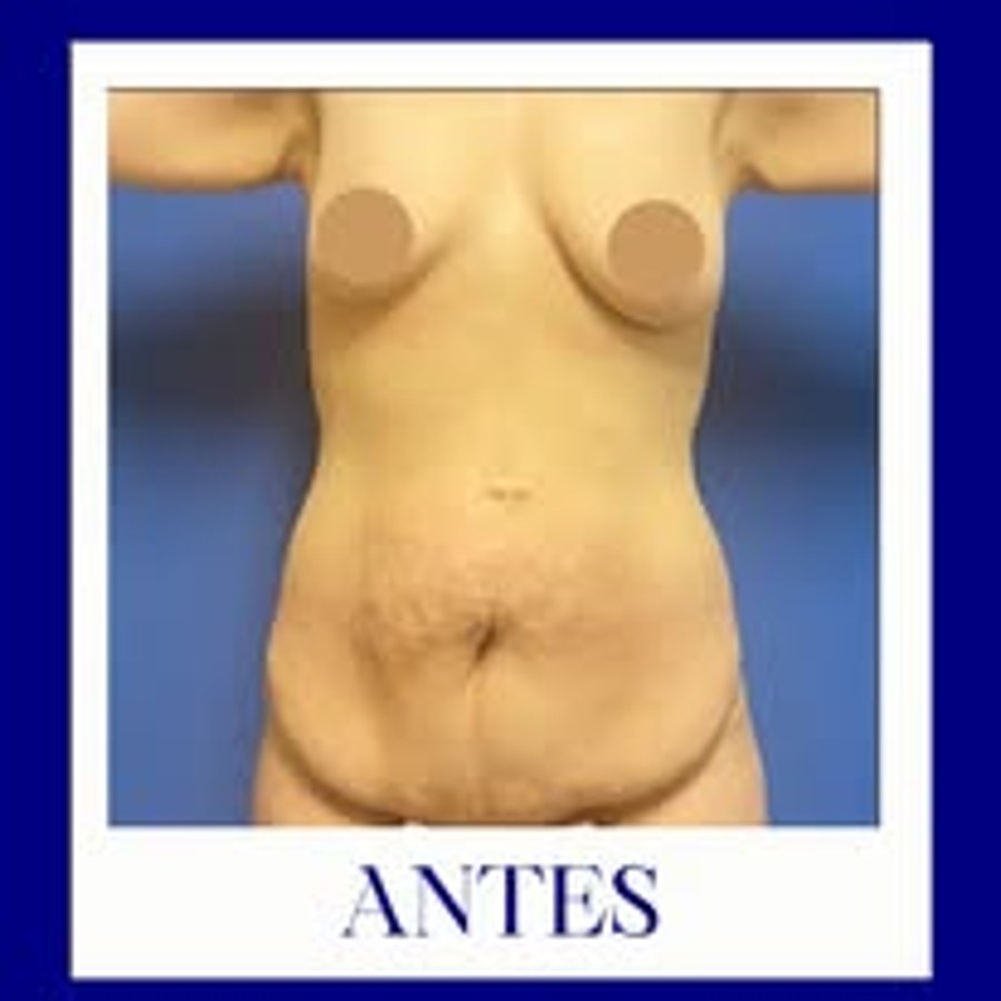 Antes abdominoplastia
