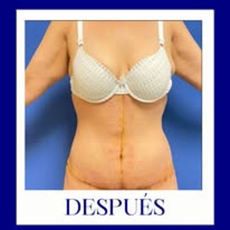 Después abdominoplastia