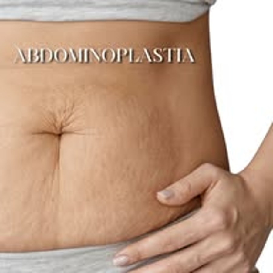 Abdominoplastia