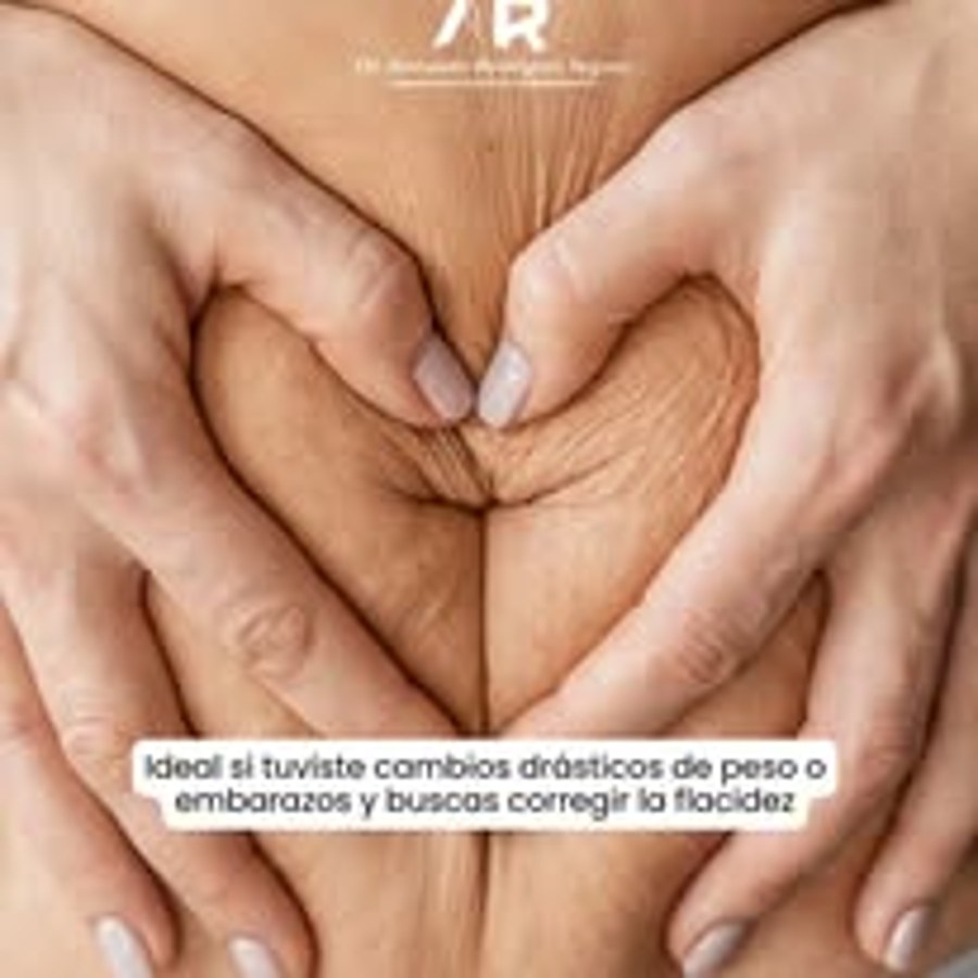 Información abdominoplastia